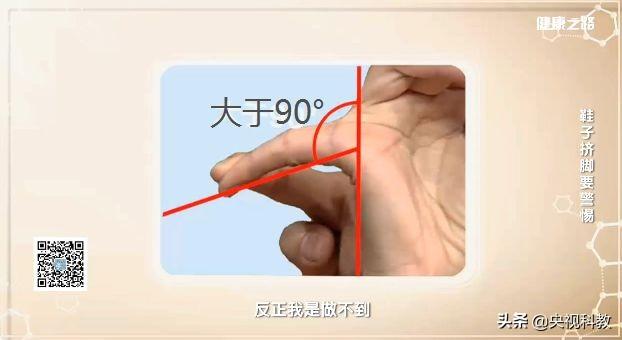 小拇指外翻怎么矫正，让你又丑又疼的拇外翻矫正方法在这里