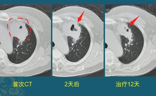 碘酒过期了还能用吗，过期了的碘酒还能不能用（硬扛3天不吃抗生素必后悔）
