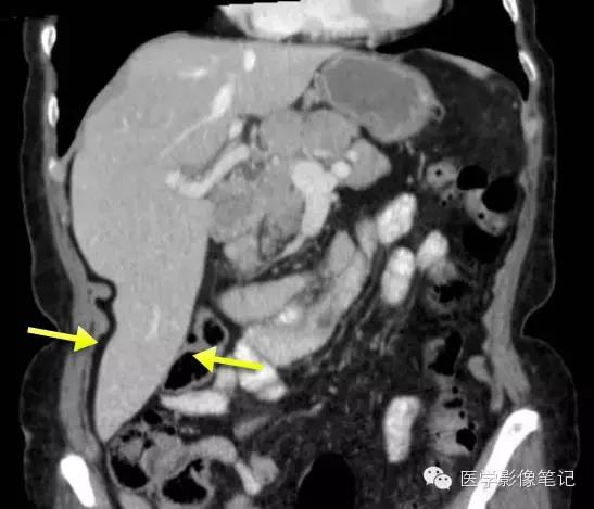 吃赖尿虾的好处，孕妇可以吃濑尿虾吗中期（这8种肝脏变异）