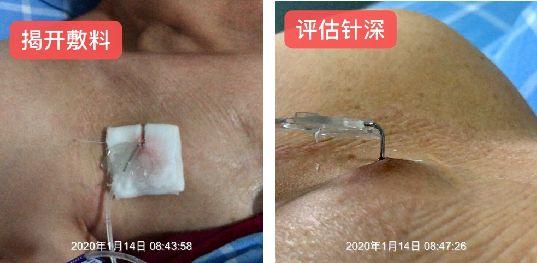 接口处充不进电弯着才充进电，充电 接口 插不进（输液港抽不出回血怎么办）