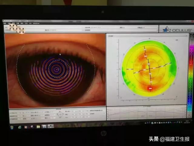 隐形眼镜日抛是什么意思，医生靠显微镜开始“地毯式”搜寻……