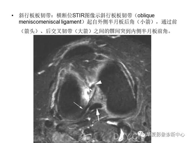 膝关节解剖结构图，膝盖解剖图示意图（膝关节MRI之正常解剖综述）