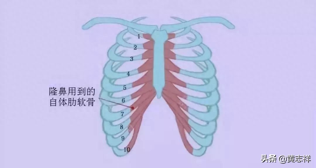 自体软骨隆鼻多久恢复正常(自体软骨隆鼻恢复图片)