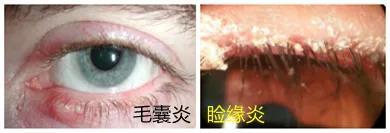 除螨皂一天用几次，除螨皂一天用几次最好（冬天是螨虫的“活跃”期）