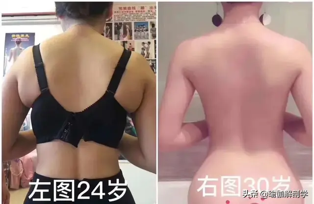 肩颈变厚了还能瘦回去吗，瘦肩针一针大概多少钱（7个瑜伽动作还你纤薄少女背）