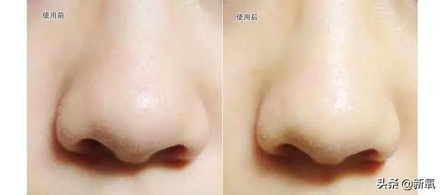 怎么去黑头小窍门，五个去黑头方法（我把火爆全网的去黑头方法试了一遍）