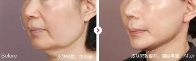 超声波治疗仪的作用与效果，超声波治疗仪应用及功能作用（突然变老的皮肤“超声刀”有效果吗）