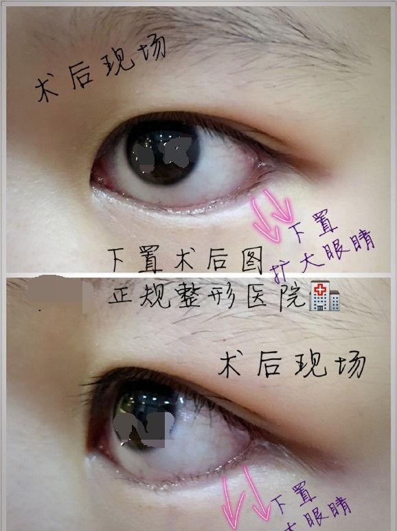 三白眼是什么意思，下三白眼的女人（下睑下至注意分寸）