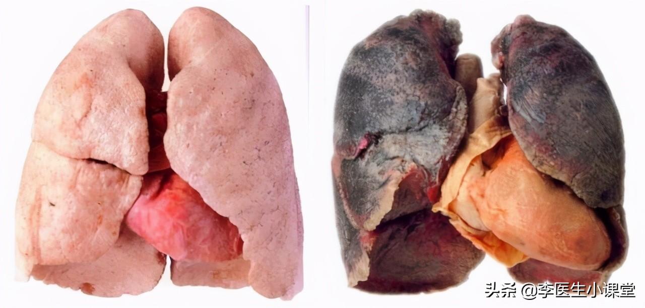 戒烟一年肺部图片图片