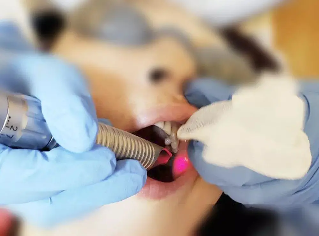 fotona是什么意思，fotona4d和热玛吉哪个效果好（欧洲之星到底值不值得做）