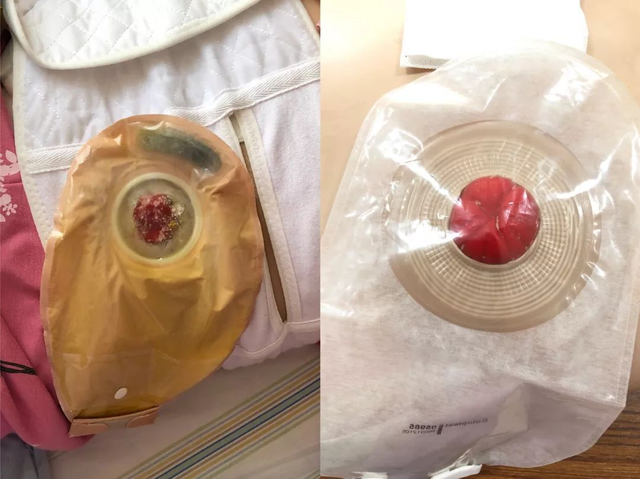 什么情况下要人造肛门，我国“造口人”超百万