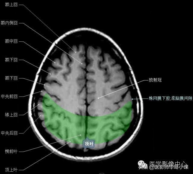 颅脑mri(头部MRI)插图(25)