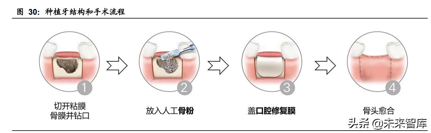 品奥（种植牙行业深度报告）