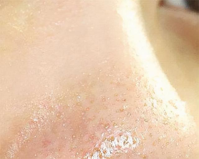 满虫咬皮肤是什么样子求图，螨虫咬的包是啥样子（3看轻松判断脸上是有螨虫）