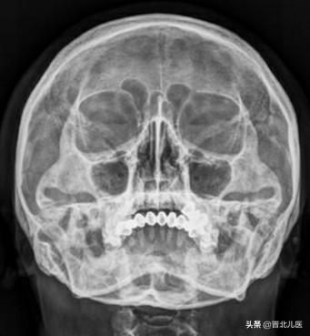 瓦氏位怎么摆位置，瓦氏位柯氏位梅氏位斯氏位（常见头颅X片）