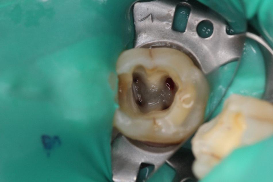 既然截掉牙神经危害还有那么多,那能不能不根管治疗?