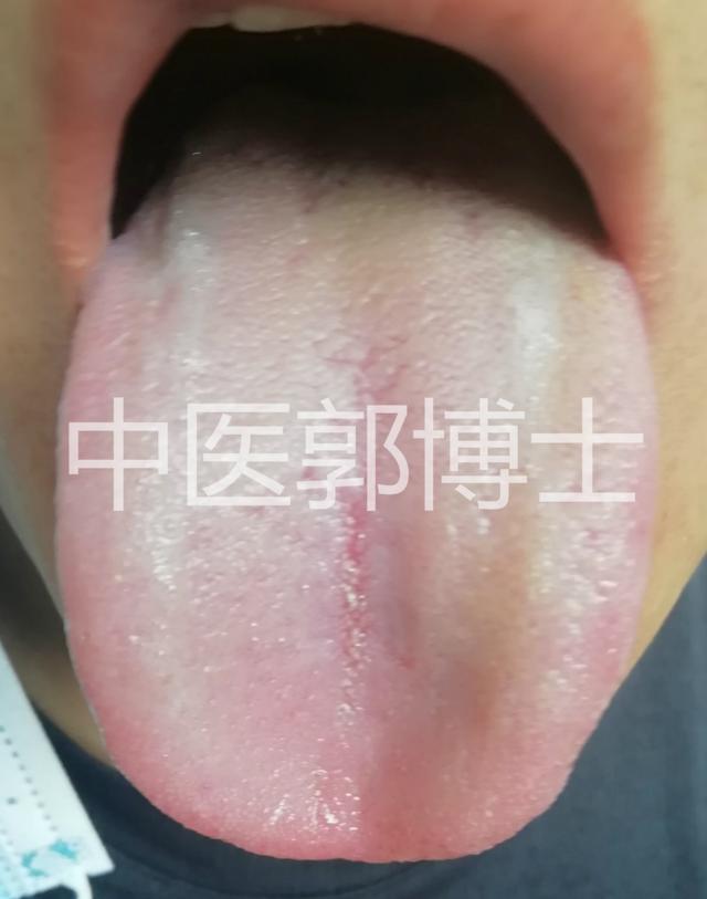 头和脖子爱出汗是什么原因女人，女人头部和颈部爱出汗（切不可单纯止汗）