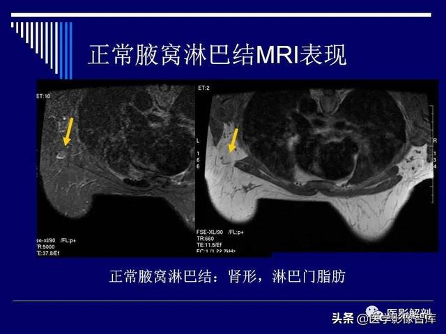 乳房解剖学基础知识，乳腺解剖及乳腺各病变影像诊断与鉴别