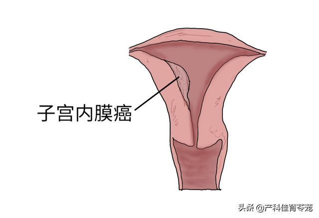 有一点点血又不像月经，有一点点血又不像月经怎么回事（好久不来大姨妈，警惕三种情况）