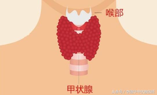 女性甲亢早期脖子图片，脖子大怎么办（请关注脖子上的“小蝴蝶”）