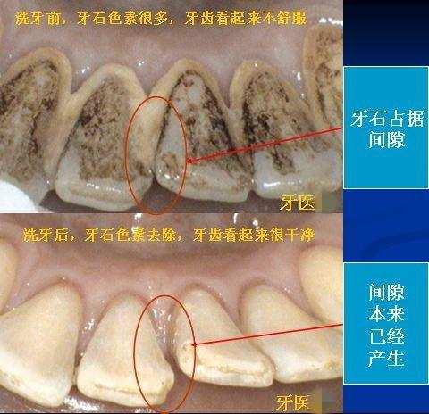 洗牙的危害有哪些，洗牙的危害有哪些方面（千万别再被“忽悠”了）