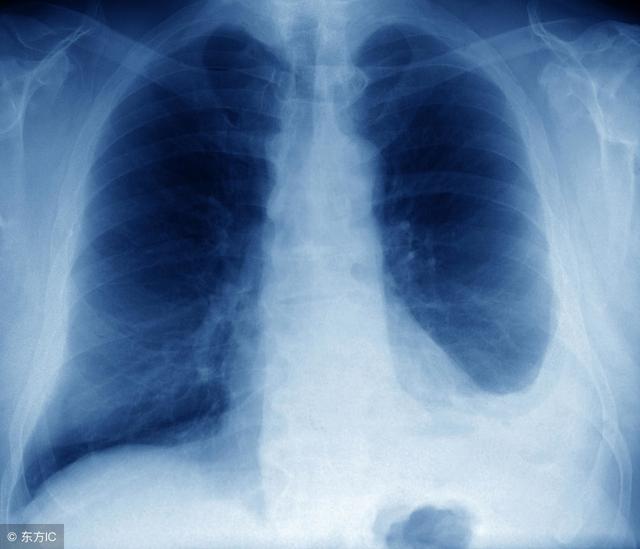 胸水怎么办，胸腔积液疾病有3种表现形式（胸水的处理方法）