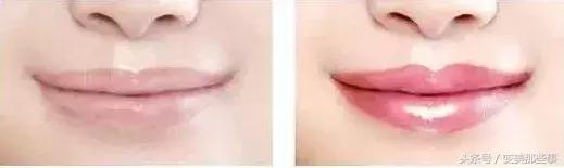漂唇手术术后护理，漂唇术后图片（决定了你的美貌程度）