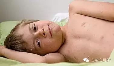 幼儿急疹得了体质变好，幼儿急疹是好事吗（急疹、湿疹、风疹、水痘、幼儿各种疹子的症状及护理）