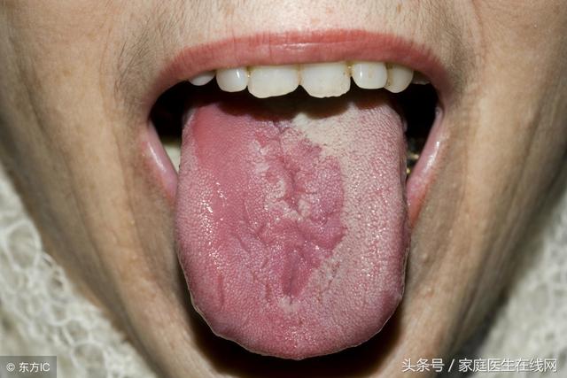 舌头上火了吃什么降火最快，哺乳期上火吃什么降火最快（可以试试这2个小妙招）