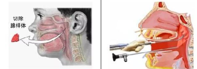 小孩扎四缝有没有危害，小儿扎四缝的副作用（腺样体肥大的危害不只是宝宝张嘴睡）