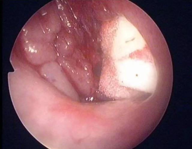 小孩扎四缝有没有危害，小儿扎四缝的副作用（腺样体肥大的危害不只是宝宝张嘴睡）