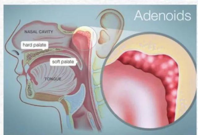 小孩扎四缝有没有危害，小儿扎四缝的副作用（腺样体肥大的危害不只是宝宝张嘴睡）