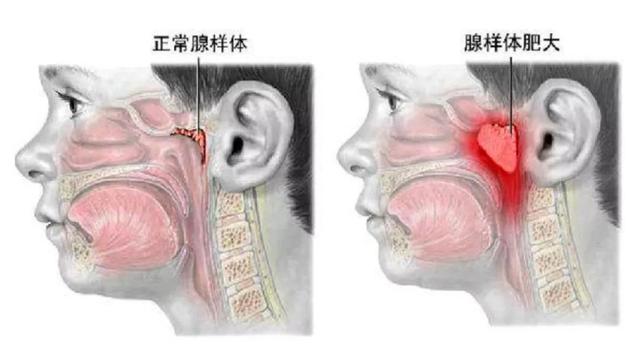 小孩扎四缝有没有危害，小儿扎四缝的副作用（腺样体肥大的危害不只是宝宝张嘴睡）