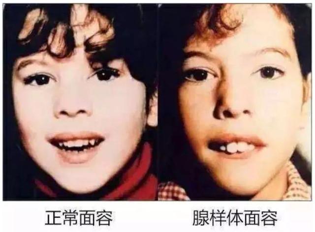 小孩扎四缝有没有危害，小儿扎四缝的副作用（腺样体肥大的危害不只是宝宝张嘴睡）