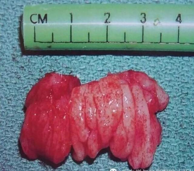 小孩扎四缝有没有危害，小儿扎四缝的副作用（腺样体肥大的危害不只是宝宝张嘴睡）