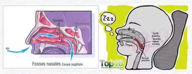 小孩扎四缝有没有危害，小儿扎四缝的副作用（腺样体肥大的危害不只是宝宝张嘴睡）