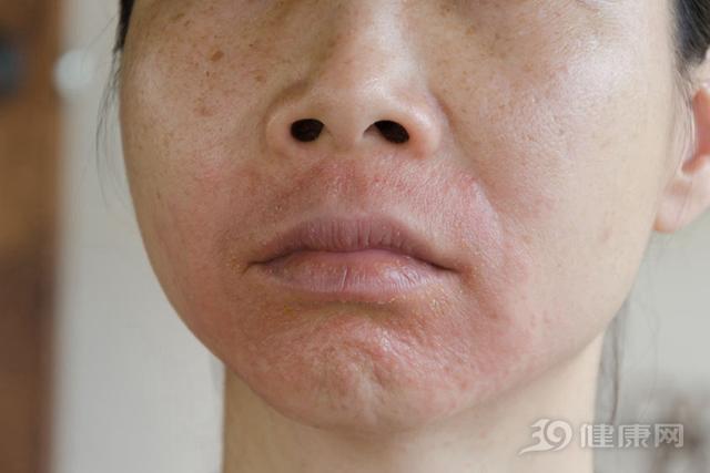 脸过敏怎么办好，脸过敏该咋办（医生教你4招，快速止痒）