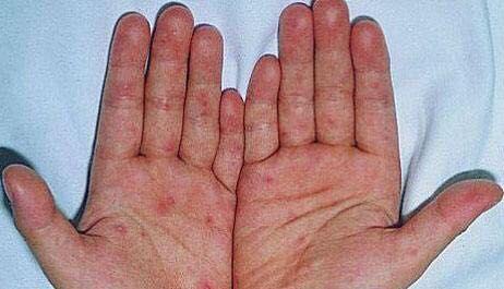 手足口病痒不痒,手足口病到底痒不痒(手足口病到底痒不痒?会留疤吗)