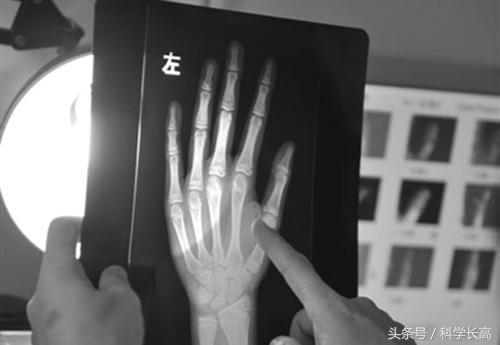 自测骨骼闭合小方法，判断骨骼闭合小方法有哪些（骨骺线闭合怎么看）