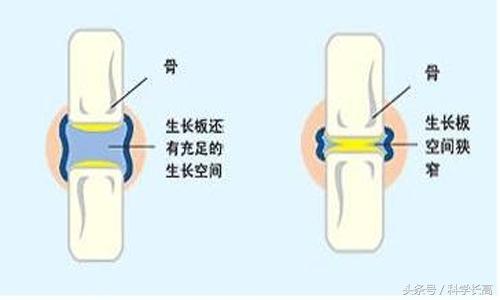 自测骨骼闭合小方法，判断骨骼闭合小方法有哪些（骨骺线闭合怎么看）