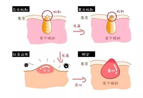 脸上有闭口怎么办，脸上有好多密密麻麻的闭口怎么办（用这2种办法可以迅速减轻症状）