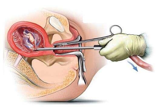 早期怀孕怎么流产好，怀孕初期怎么快速流产（早期妊娠的流产方法及流产后的护理）