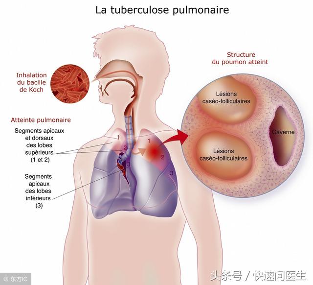 肺结核的潜伏期，肺结核的潜伏期是多久（肺结核病潜伏期难察觉）