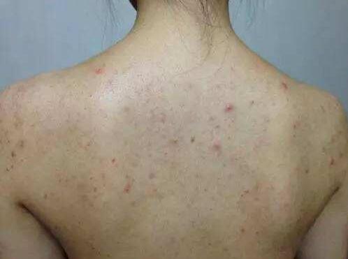 螨虫后背痒怎么办,后背痒有螨虫怎么办(总算找到后背螨虫的"死对头"了