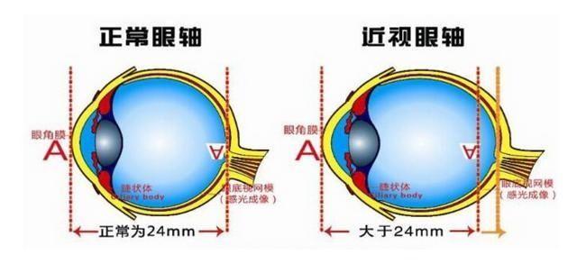 近视眼的形成原理，了解近视眼的形成原因以及眼睛的工作原理（人为什么会得近视）