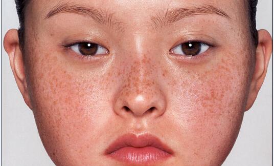 怎样去掉蒙脸沙，蒙脸沙最好的去掉方法（孕妇！拒绝！蒙脸痧！）