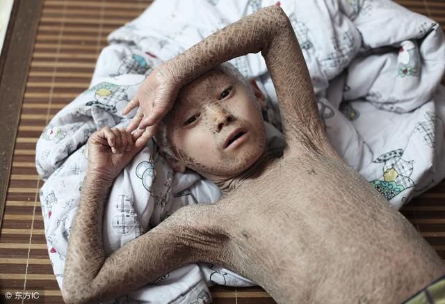 鱼鳞病是什么样子的图片，鱼鳞病的症状（生活中要懂得鱼鳞病的预防）