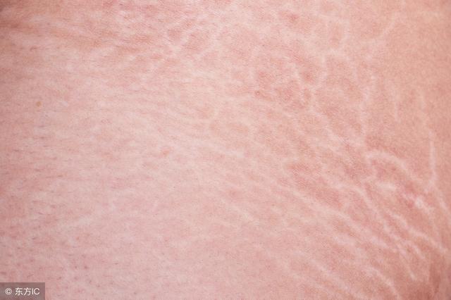 鱼鳞病是什么样子的图片，鱼鳞病的症状（生活中要懂得鱼鳞病的预防）