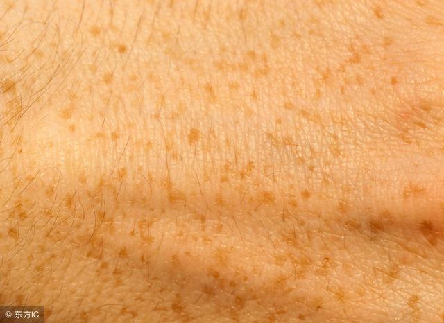 鱼鳞病是什么样子的图片，鱼鳞病的症状（生活中要懂得鱼鳞病的预防）