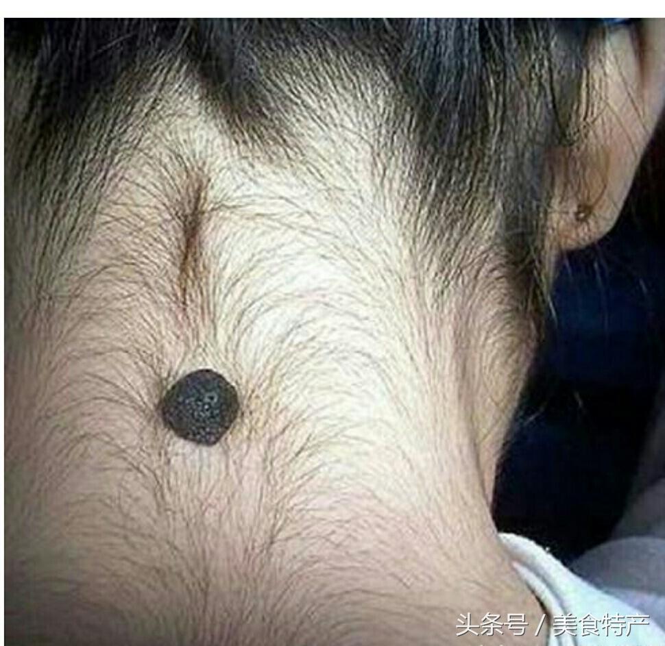 长在脖子后面的痣是什么痣,脖子后面长了一颗痣是什么意思 - 珍缘易学
